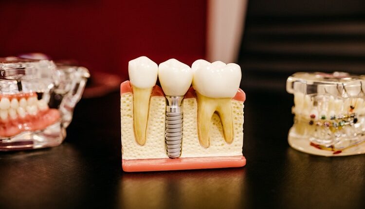 Dental Implants